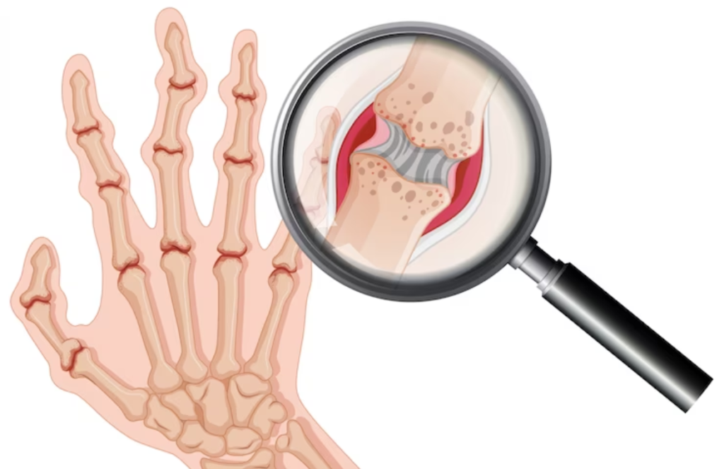 Rheumotology Overview: Exploring Autoimmune Diseases