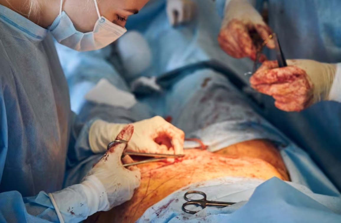 Role of General Surgery in Hernia Repair