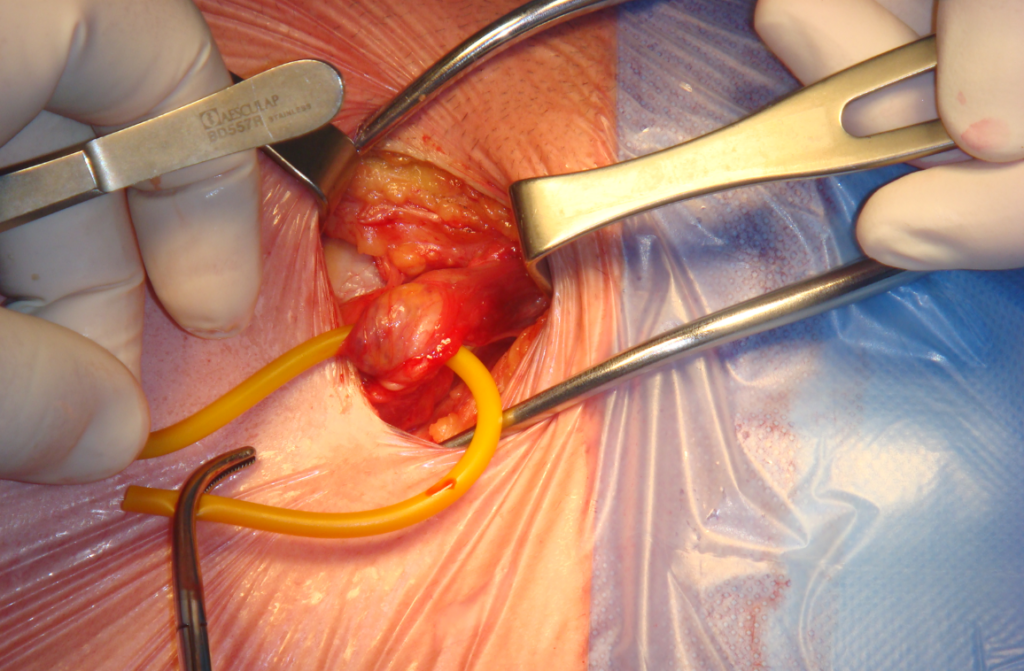 Role of General Surgery in Hernia Repair