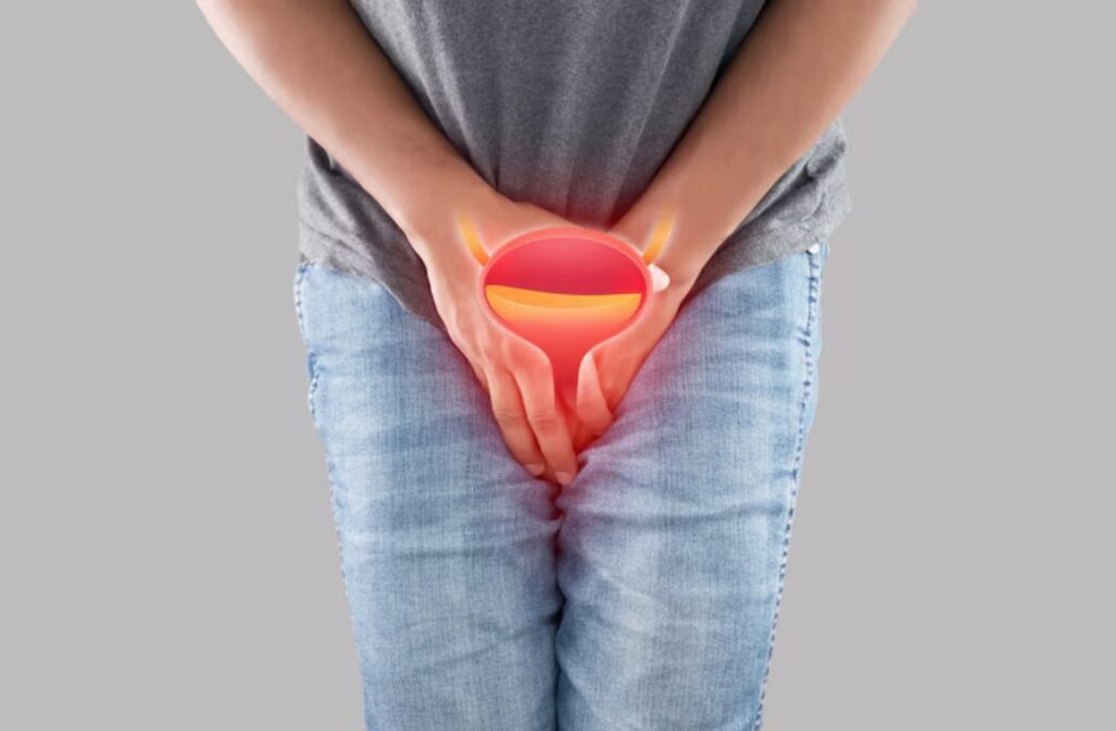 Differences in Bladder Stone Symptoms in Men and Women