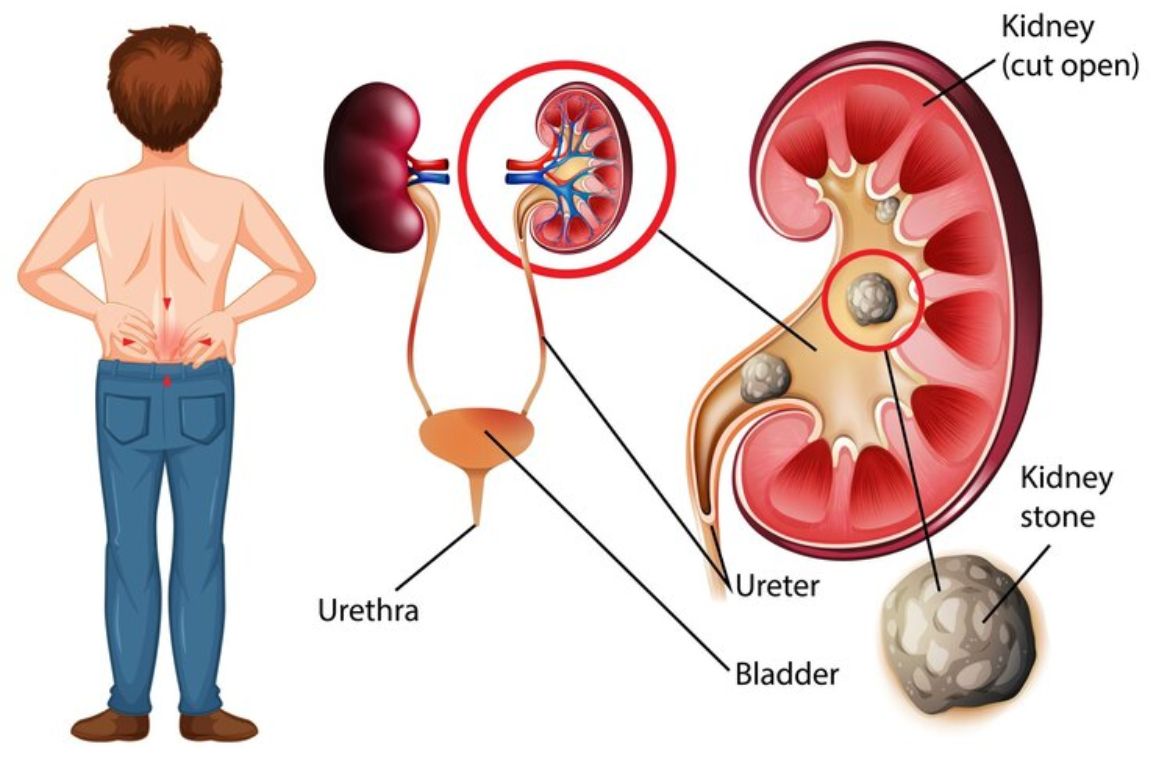 Kidney Stones Causes, Types, Symptoms, and Treatment